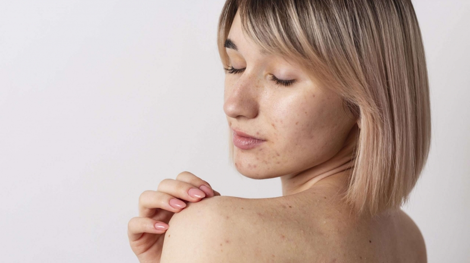 zincul trateaza acneea